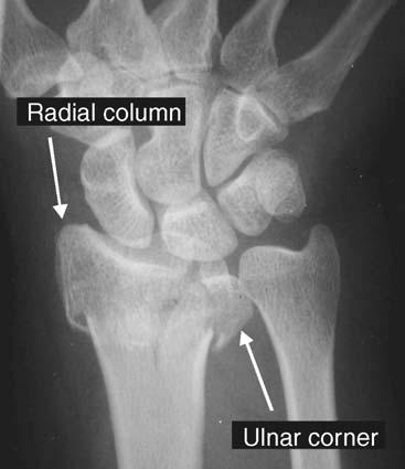 DISTAL RADIUS FRACTURES: RADIOGRAPHIC EVALUATION 287 Fig. 16. Simple intra-articular fracture with large radial column and ulnar corner fragment. a full 180( and facing proximally.