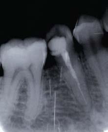 The decision ws mde to re-tret this tooth, efore completion of the competence.