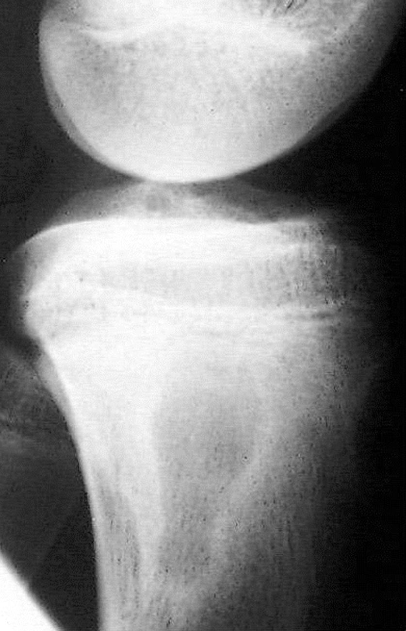 This is an example of a giant-cell tumor of acute osteomyelitis of the proximal part