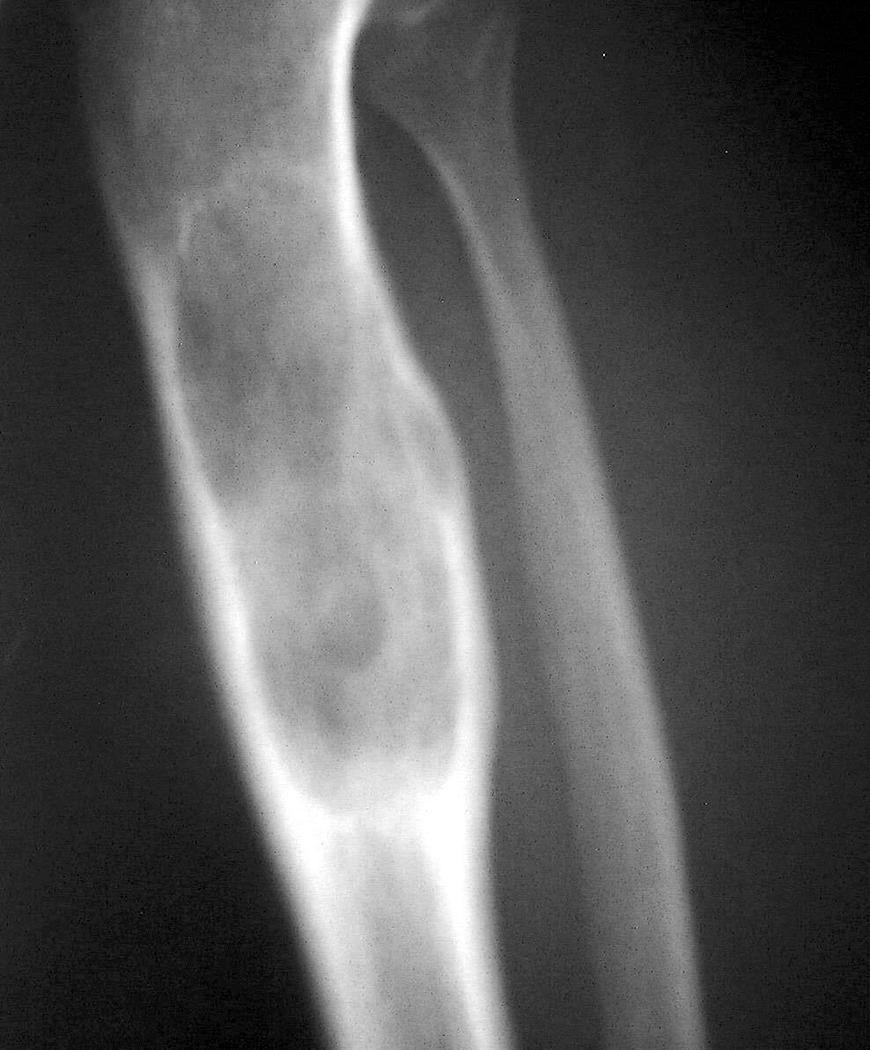 lesion. These lesions can be amorphous calcification, bone, or cartilage. Amorphous calcification, as its name implies, is a collection of calcifications without a well-defined matrix.
