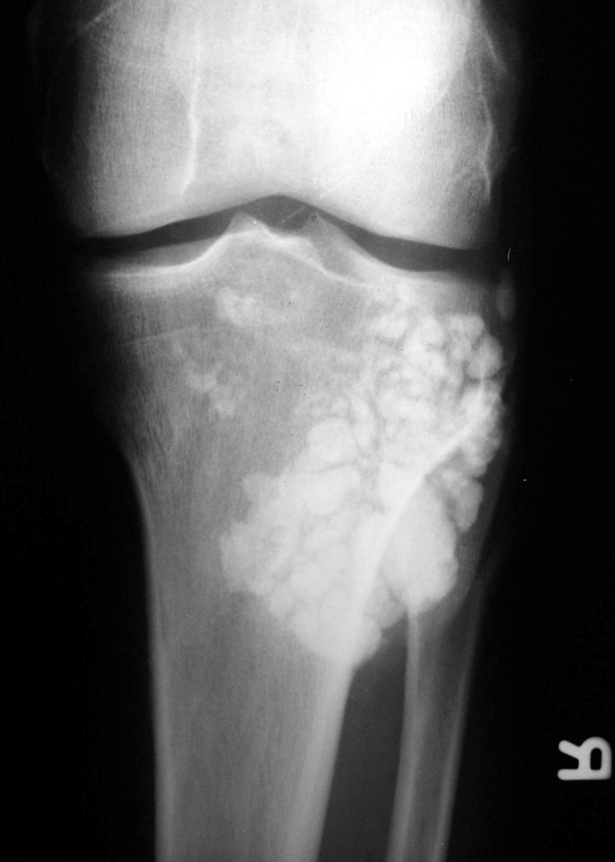Cartilage lesions appear with characteristic rings and stipples on plain radiographs.