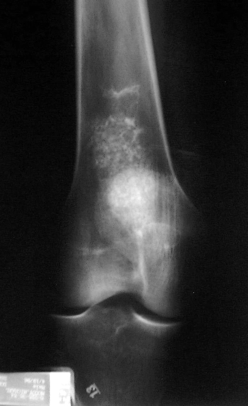 Both benign and malignant cartilage processes have this radiographic pattern. Cartilaginous lesions may be divided into intramedullary lesions and surface lesions.