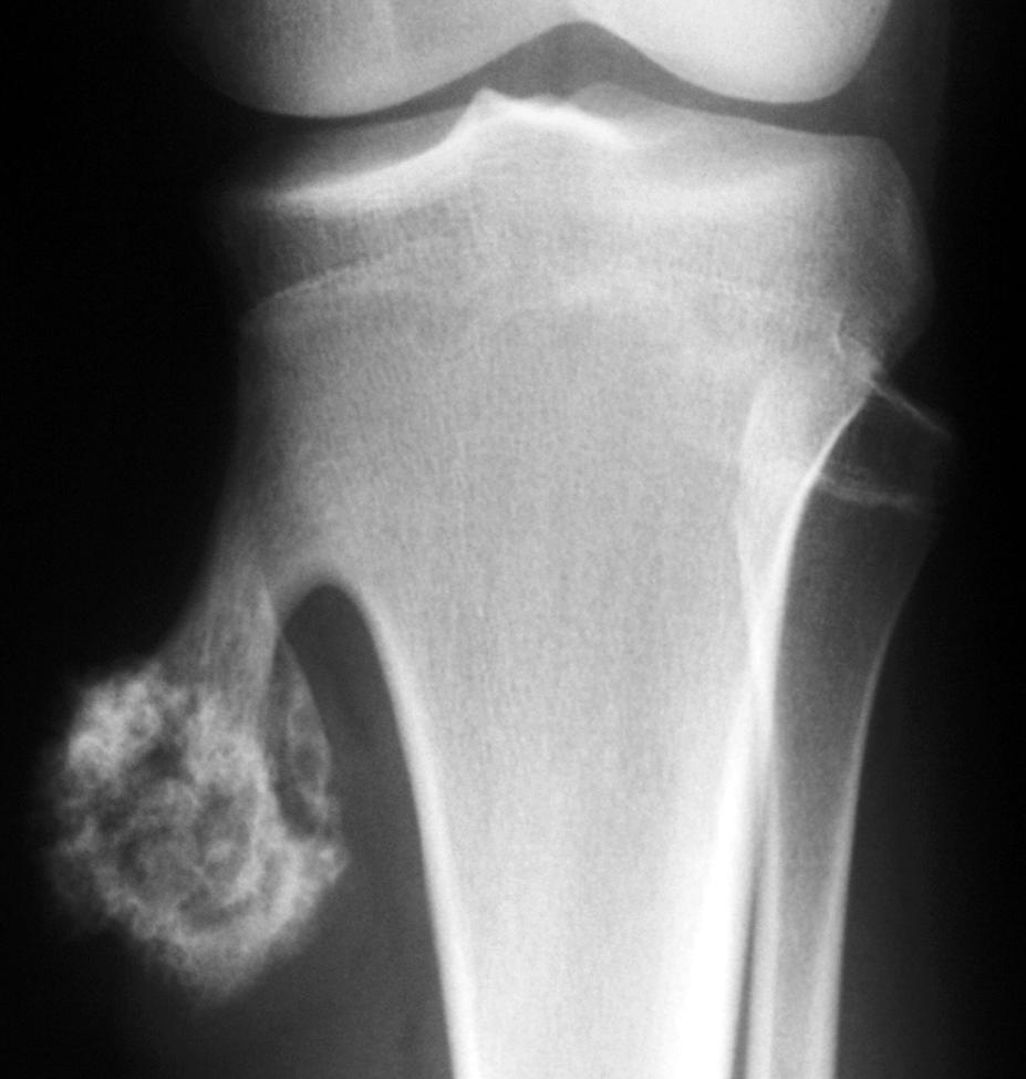 Fig. 9 Osteochondroma of the proximal part of the tibia. This lesion is a benign extraosseous cartilage bone tumor. Note the welldefined margins and its continuity with the medullary canal.