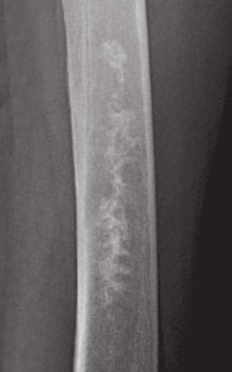 Caracciolo et al. Fig. 6 Grade III lesion in 68-year-old woman., Lateral radiograph of femur shows mineralized central medullary diaphyseal lesion.