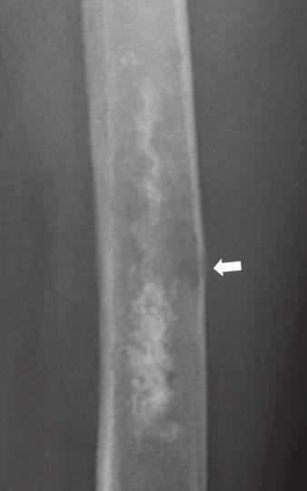 , Obtained 8 years after, follow-up radiograph shows change in margination.