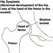 Variations in the depth or shallowness of the hip socket: causing the head of the femur to misalign in the hip socket.