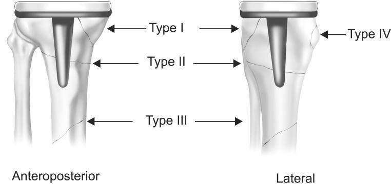 fractures are located at the tibial plateau, type II fractures occur inferior to the tibial plateau adjacent to the prosthetic stem, type III fractures occur distal to the tibial stem and type IV