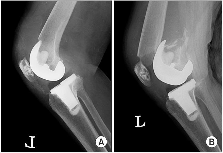 (B) Lateral radiograph showing a displaced supracondylar femoral fracture of the same patient.