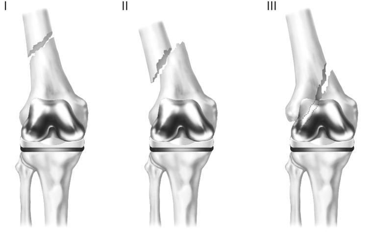 Figure 3: Classification of supracondylar femoral fractures above total knee arthroplasty described by Rorabeck and Taylor[10].