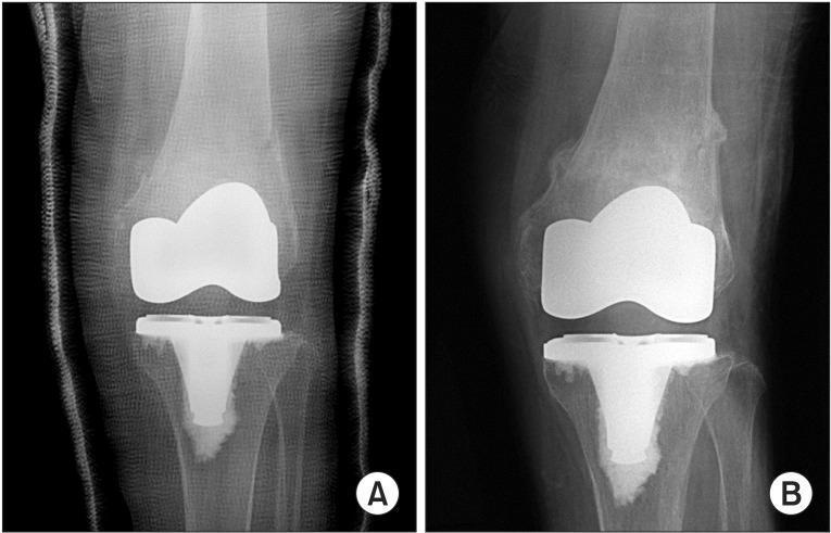 Figure 4: (A) Anteroposterior radiograph showing a minimally displaced supracondylar femoral fracture treated with cast immobilization.