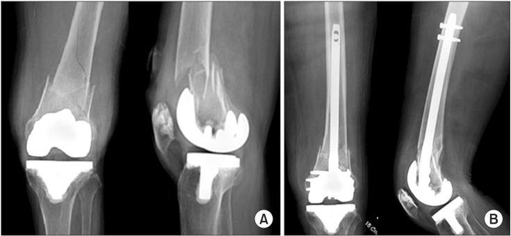 Rorabeck type II supracondylar femoral fractures yields high union rates and excellent functional improvement[22].
