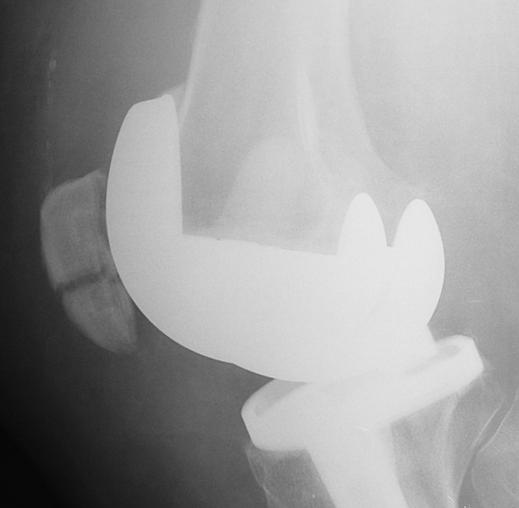 Fig. 1 59-year-old woman with transverse fracture of right patella 12 months after total knee replacement., Lateral radiograph of right knee shows linear nondisplaced fracture at mid patella.