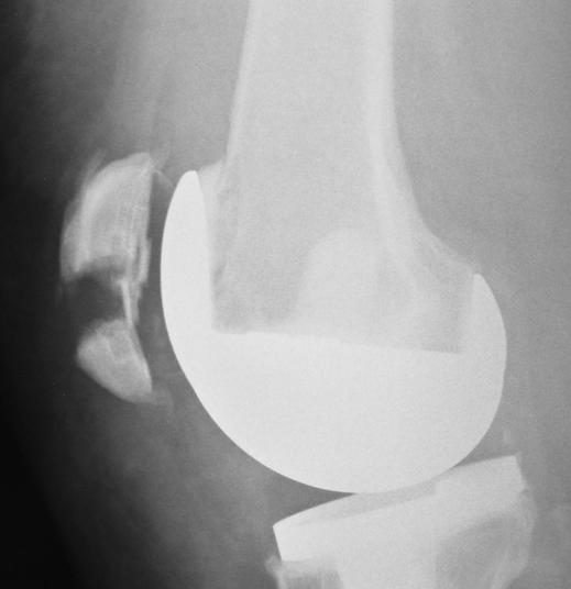 Pain in right knee had increased substantially since radiography examination 12 months earlier (). patients.
