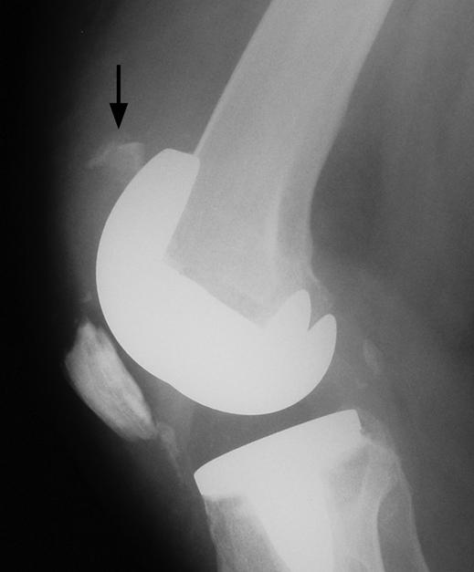 Patellar Fractures fter Total Knee Replacement had persistent pain and extensor weakness. Two fractures healed.