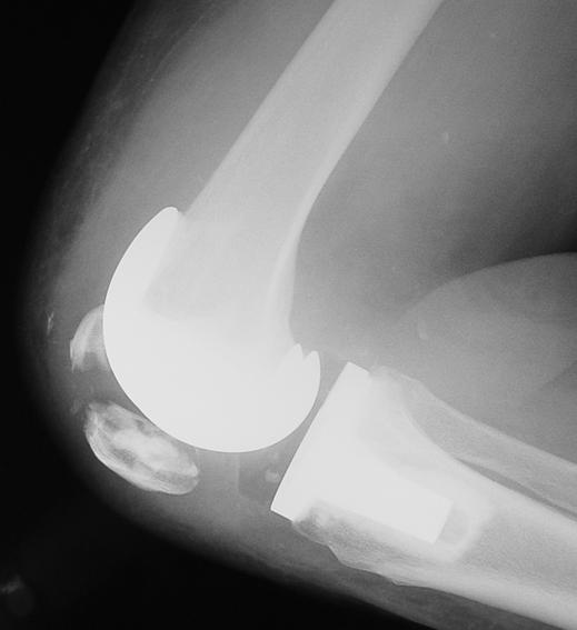 Fig. 3 82-year-old woman with comminuted fracture of right patella 2 months after total knee replacement.