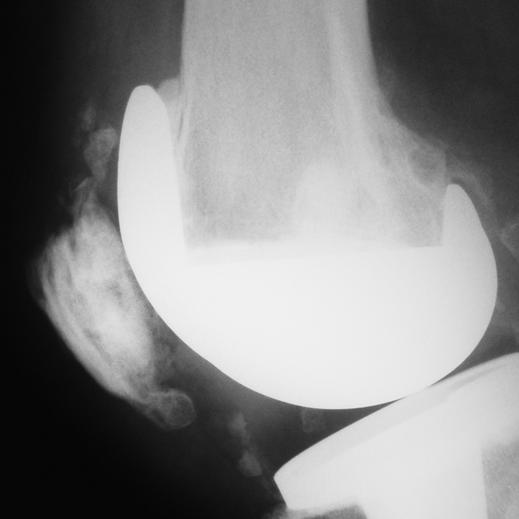 and, Lateral radiograph () and Merchant view () show fracture with fragmentation and bony sclerosis of patella.