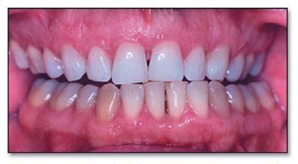 Mean Change in Gingivitis & Plaque with Treatment 14% hydrogen peroxide strips Discussion Crest Whitestrips Supreme, a thin 14% hydrogen peroxide whitening strip, represents a new approach for