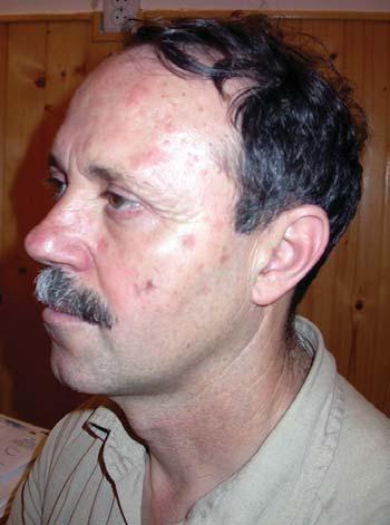 Patient with multiple AK (history of overexposure to artificial UV of a phototyped II skin) front and profile Concluzii 1.