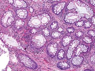 162 Fleming et al. Pathologic aspects of colorectal carcinoma to promote uncontrolled activation of the Wnt signaling pathway of tumorigenesis (74).