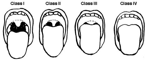 Addendum B ~ Mallampati Airway Classification Mouth: OK Small Neck: Free ROM Decreased ROM Indicate airway evaluation below: Class 1: Class 2: Class 3: Class 4: The soft palate, fauces, uvula and