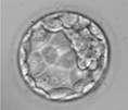 Embryo 4 Trisomy 21 Miscarriage or abnormal live birth Excluded Embryo 5 Mosaic Monosomy 2 Risk of an adverse