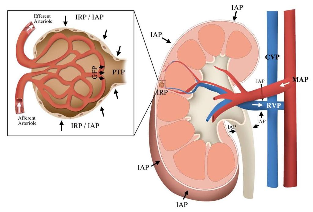 Multi-Factorial Impact of Venous Congestion and Arteriolar Resistance on Renal Function Renal Filtration Gradient: GFP - PTP IAP = intra-abdominal pressure IRP = interstitial renal pressure CVP =