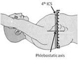 Marking the Phlebostatic Axis Phlebostatic axis is th intercostal space at mid anterior-posterior chest level (left atrial level) System needs to be zeroed and leveled at the phlebostatic axis