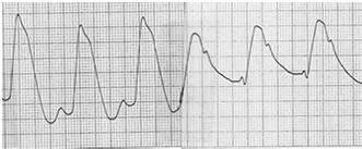 Pressure = /7 Pulmonary Artery Waveforms PA