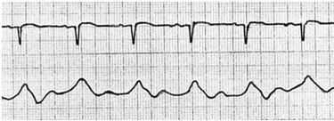 PWP Waveform Normal PAW Identify a and v waves and