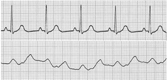 v - - Identify a and v waves and state the PWP