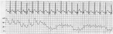 PA to PAW Spontaneous Breathing End Expiration in Ventilator Breath