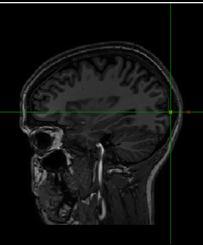 Locating Consistent Area of Visual Disruption First, a location on the subject s visual cortex was found that consistently produced a phosphene in the lower left area of the visual field.
