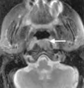 2a: Nasopharyngeal carcinoma (long arrow) and neck node metastasis (short arrow) as visible on MRI STIR coronal view 3 Dunn JE, Bragg KU, Sautter C, Gardipee C.