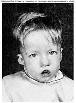 DiGeorge syndrome, a T cell development deficiency disease: Immunodeficiency due to hypoplasia of the thymus Hypocalcemia due to