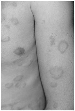 Type I- Urticaria Hives: a vascular reaction of the upper dermis marked by transient