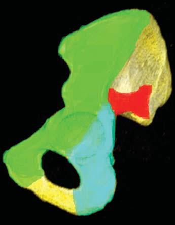 urkee et al. Radiographic and T lassification of cetabular Fractures Musculoskeletal Imaging Pictorial ssay M N U T R Y L I M I G O F I N G N. Jarrod urkee 1,2 Jon Jacobson 1 avid Jamadar 1 Madhav.