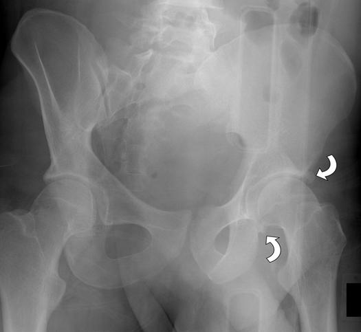 posterior wall acetabular fracture.