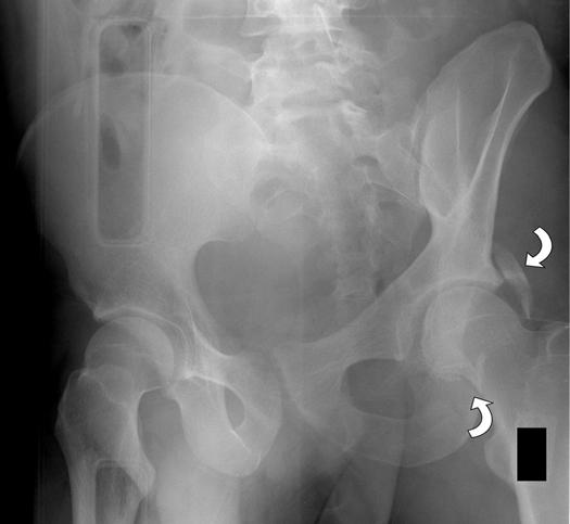 bilateral oblique pelvic radiographs (,