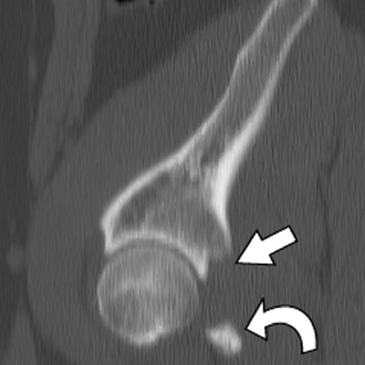 Radiographic and T lassification of cetabular Fractures Fig. 9 (continued) 18-year-old man with isolated posterior wall acetabular fracture.