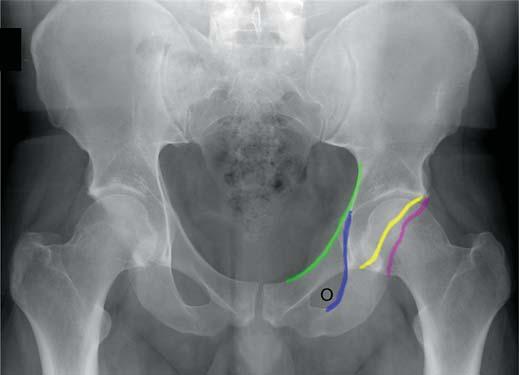 , nteroposterior radiograph shows iliopectineal line (green), ilioischial line (blue), anterior acetabular wall (yellow), posterior