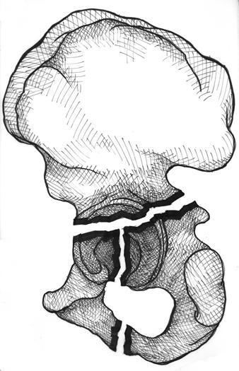 The anterior and posterior walls, which extend from the columns and support the hip joint, are well seen on an axial T (Fig. 1).