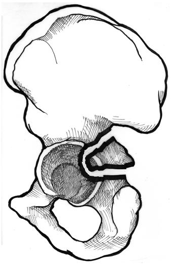 YS OTH-OLUMN FRTUR pubic ramus and a combination of the inferior pubic ramus and ischium (or ischiopubic ramus).