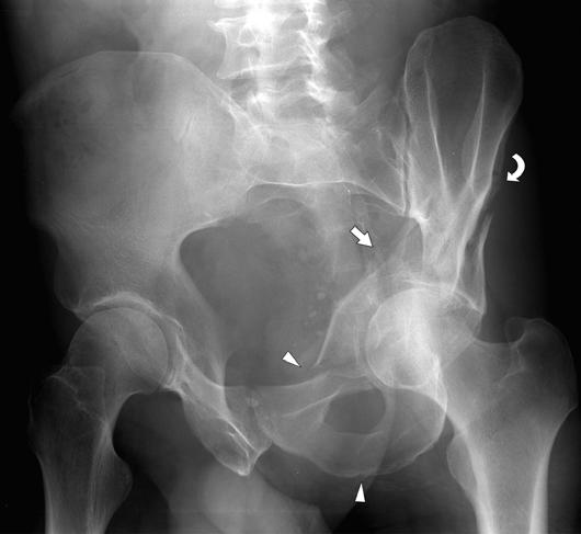 valuation of sequential T images shows the fracture, which separates the sciatic buttress from the acetabular roof. T-Shaped Fracture T-shaped acetabular fracture (Fig.