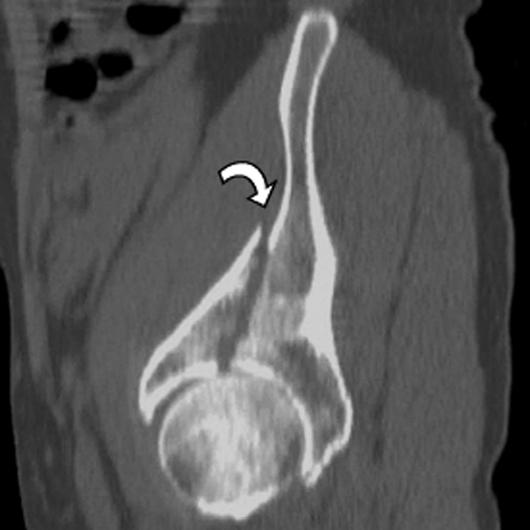 Radiographic and T lassification of cetabular Fractures Fig. 4 (continued) 45-year-old man with both-column acetabular fracture.
