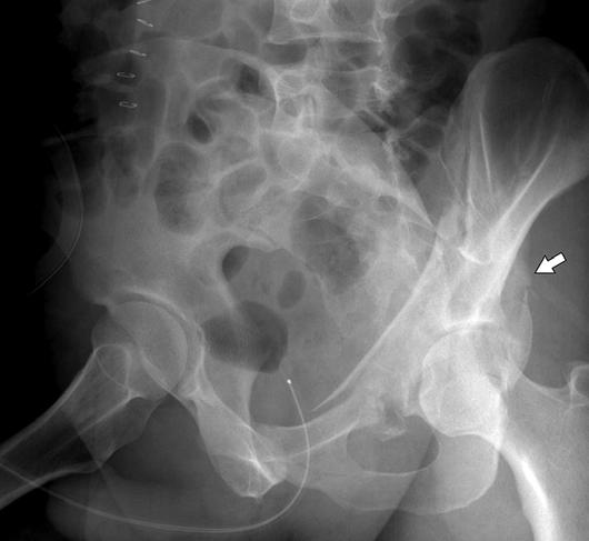 and, Oblique pelvic radiograph () and axial T image () show spur sign (arrow), which represents displacement of fracture involving sciatic buttress (arrowheads).