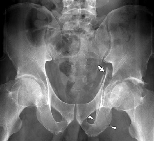 urkee et al. orientation. Therefore, on radiographs, the fracture lines that disrupt the iliopectineal and ilioischial lines course superiorly and medially in an oblique plane from the acetabulum.