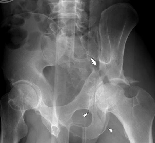 On T, this transverse fracture component is seen as a sagittally oriented fracture coursing medially and superiorly from the acetabulum.