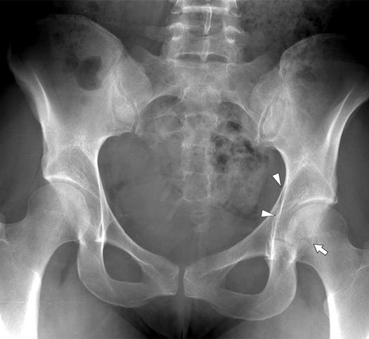 7 23-year-old woman with transverse acetabular fracture.