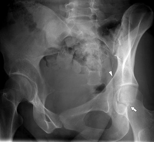 urkee et al. Fig. 7 (continued) 23-year-old woman with transverse acetabular fracture.