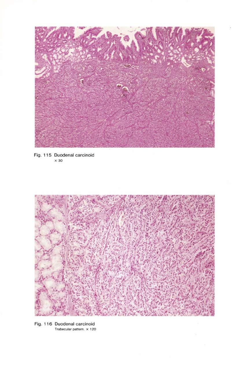 Fig. 115 Duodenal carcinoid X 30 Fig.